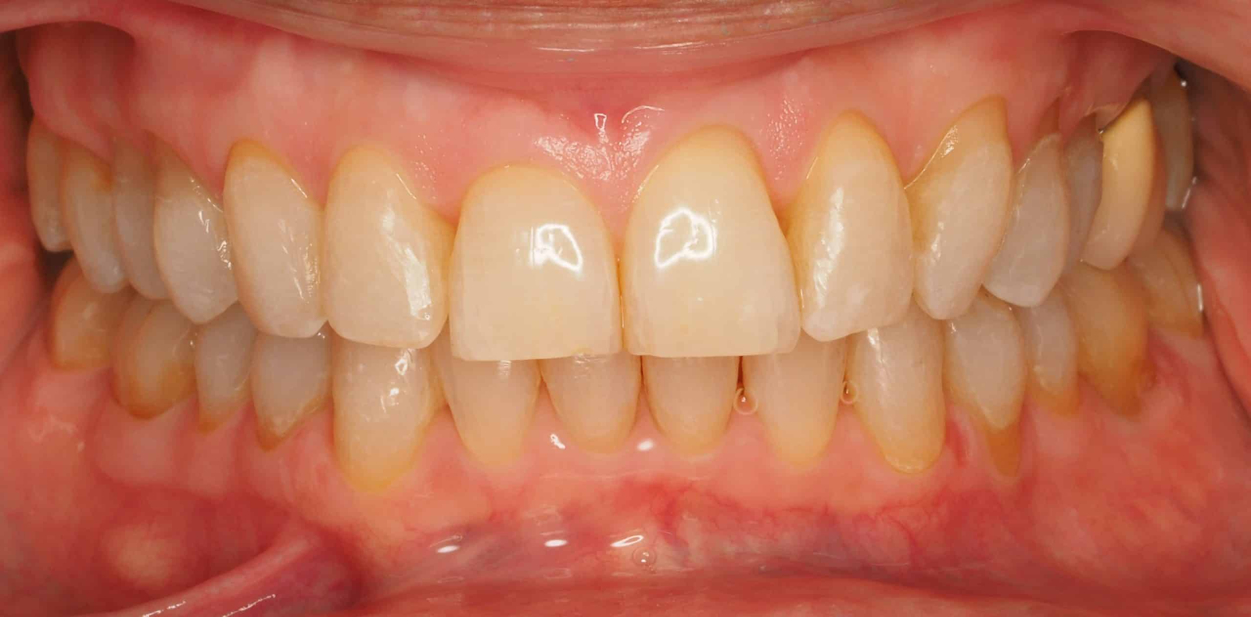 Antes y después - Dr Marc Rovira