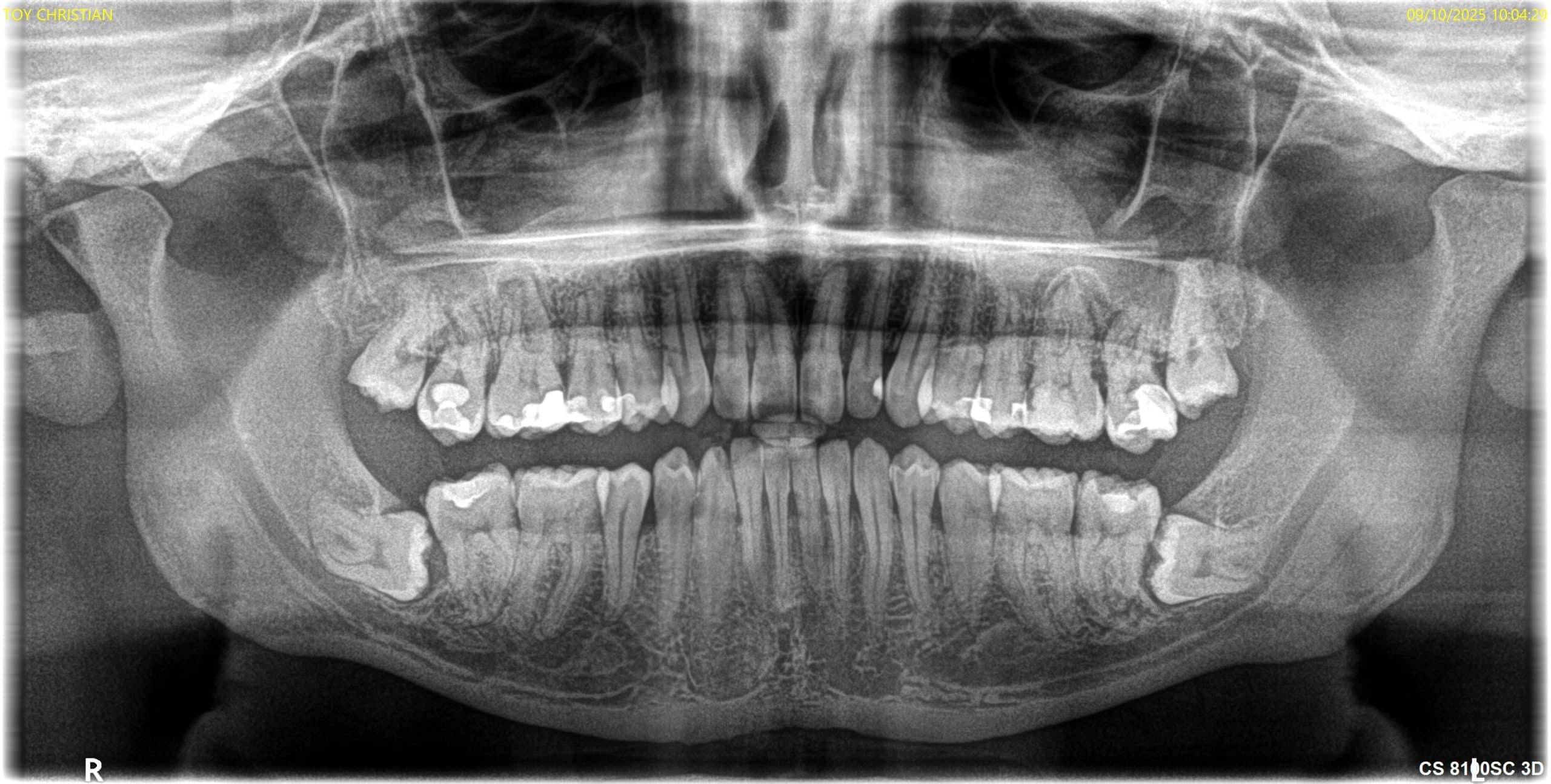 Antes y después - Dr Marc Rovira