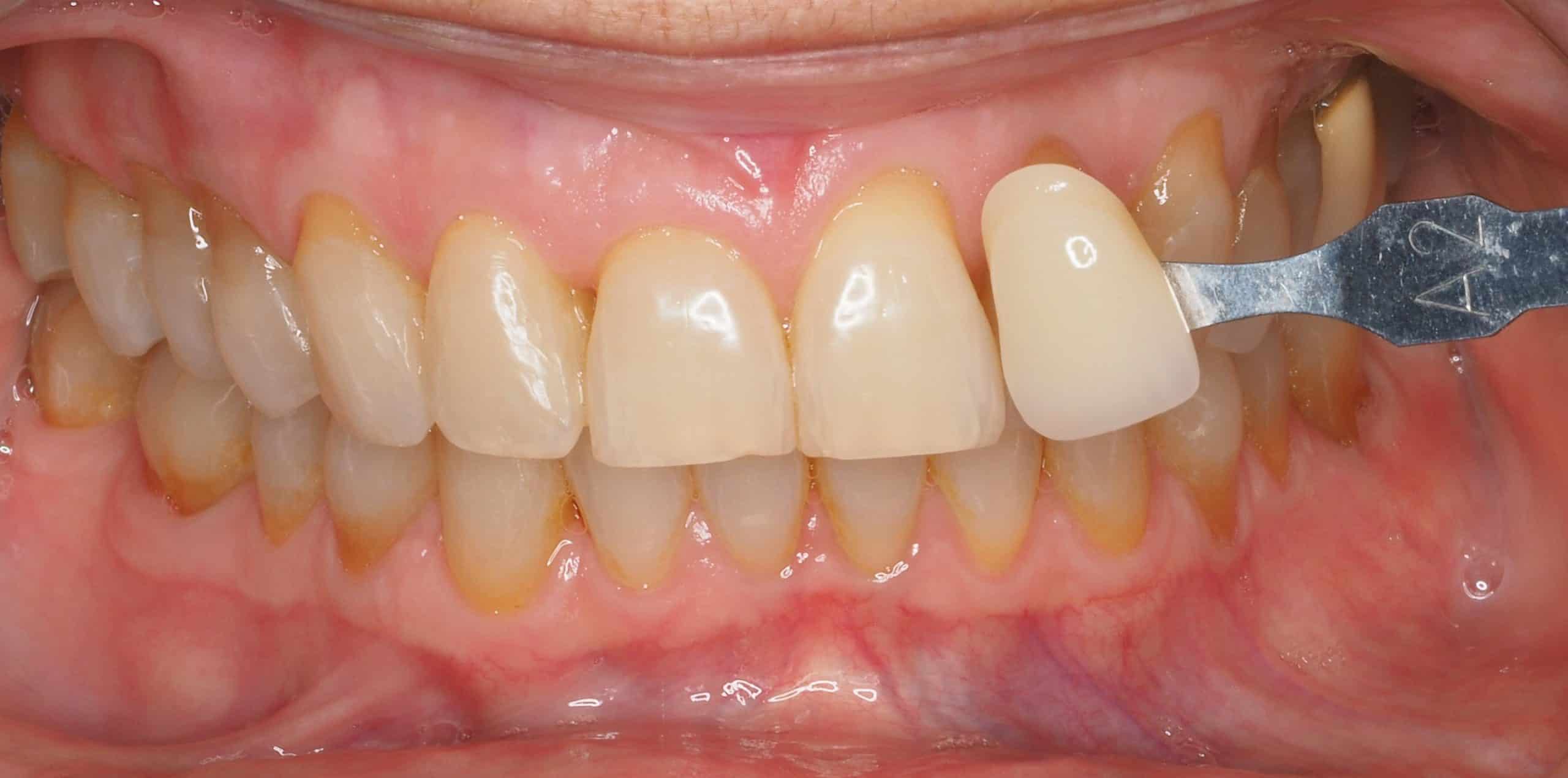 Antes y después - Dr Marc Rovira