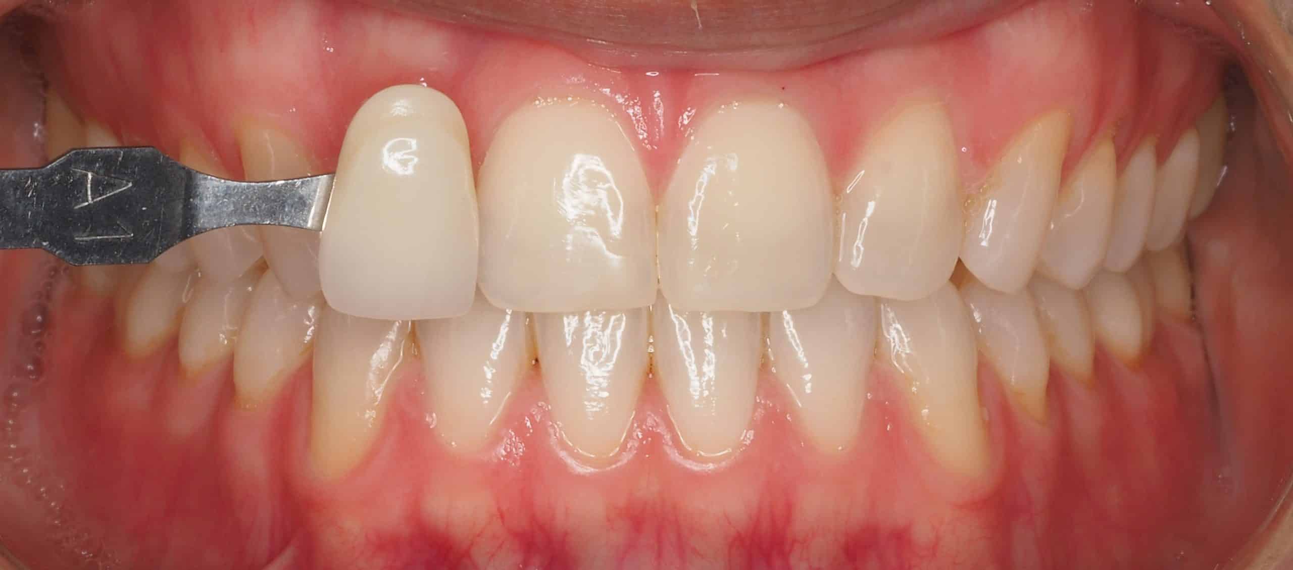 DESPRES CAS 3 blanquejament