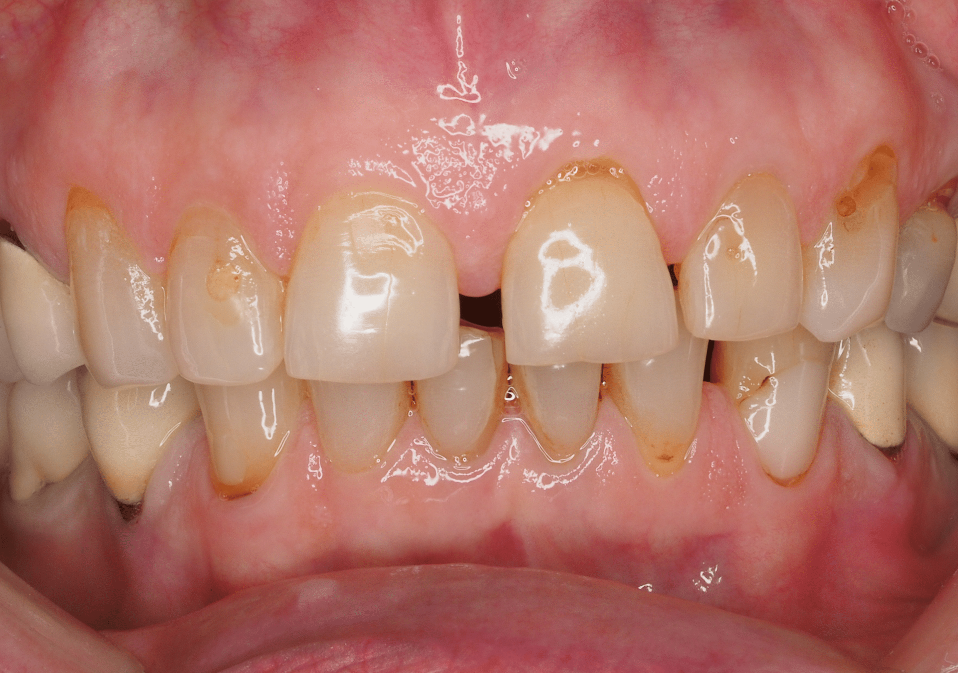 Antes y después - Dr Marc Rovira