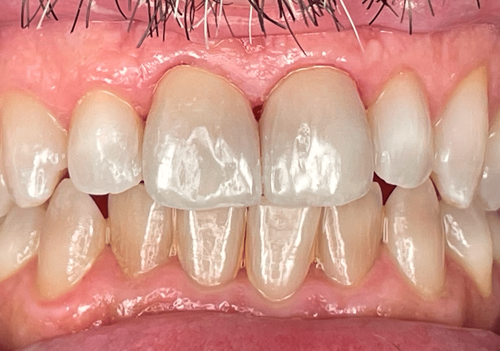 Antes y después - Dr Marc Rovira