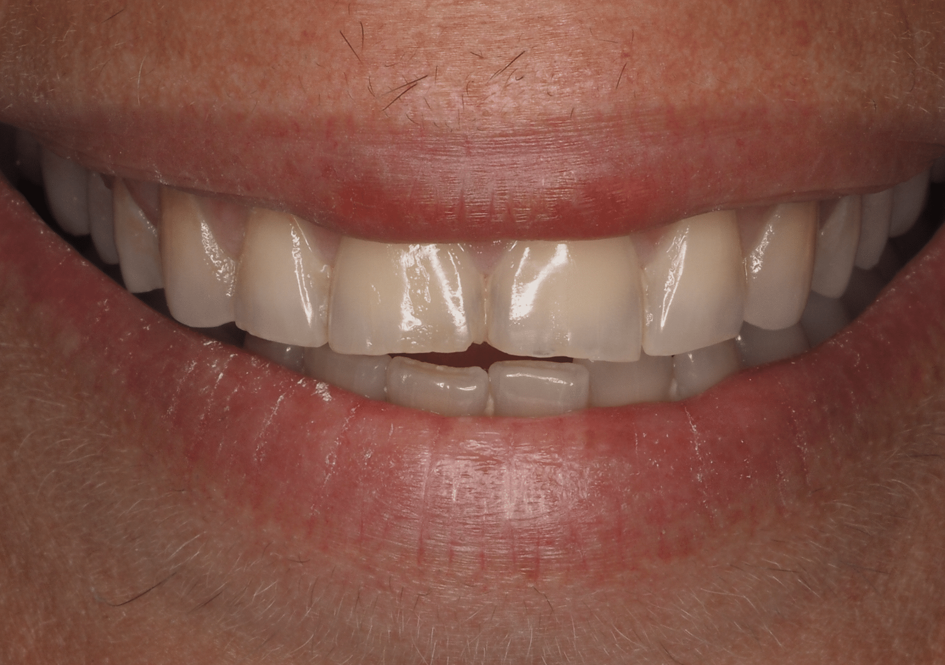 Antes y después - Dr Marc Rovira