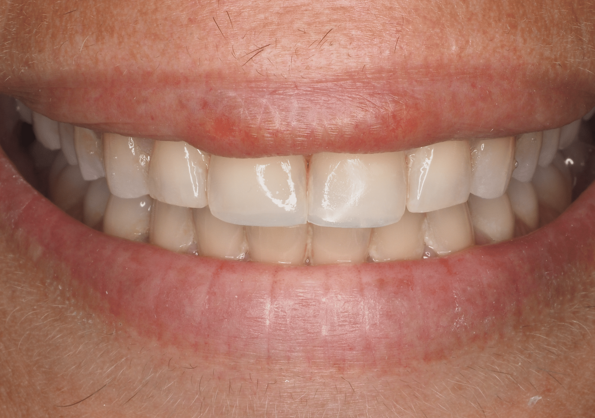 Antes y después - Dr Marc Rovira