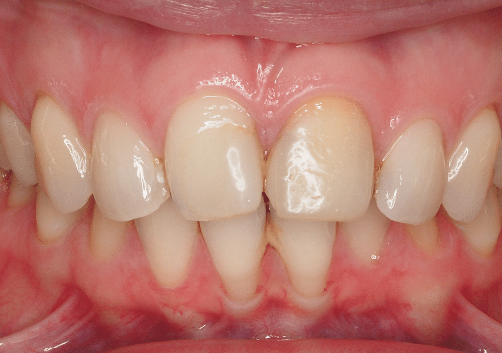 Antes y después - Dr Marc Rovira