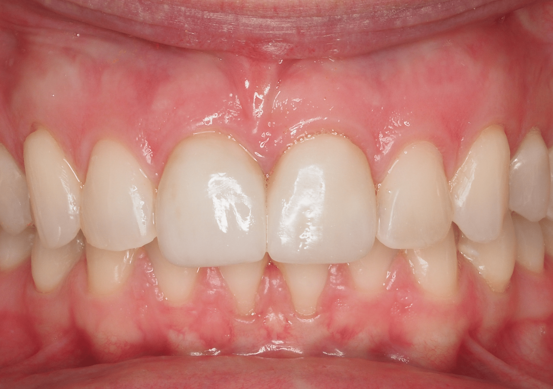 Antes y después - Dr Marc Rovira