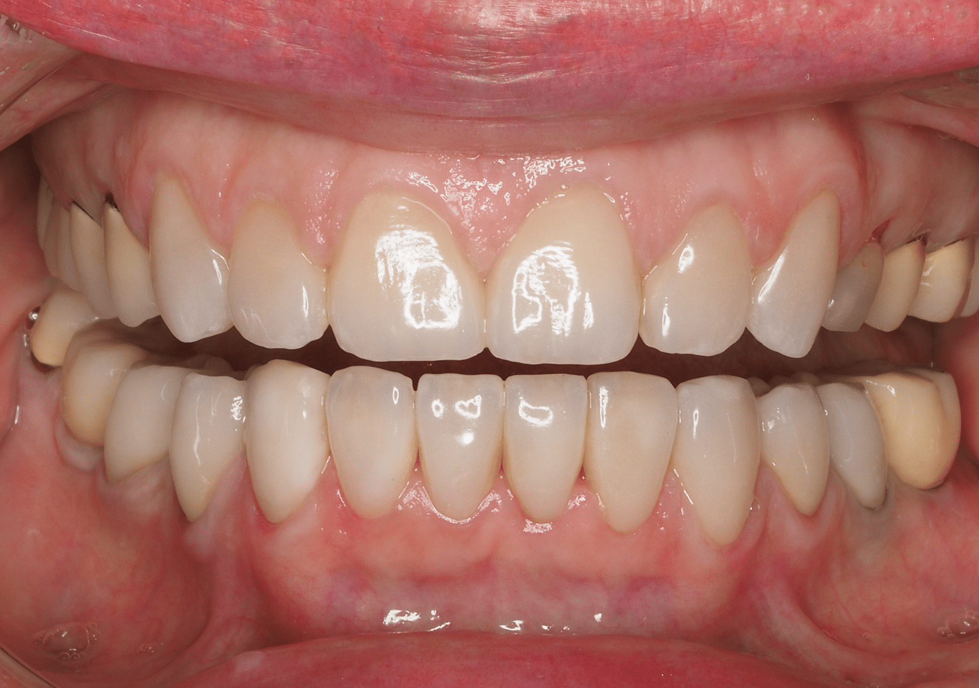 Antes y después - Dr Marc Rovira