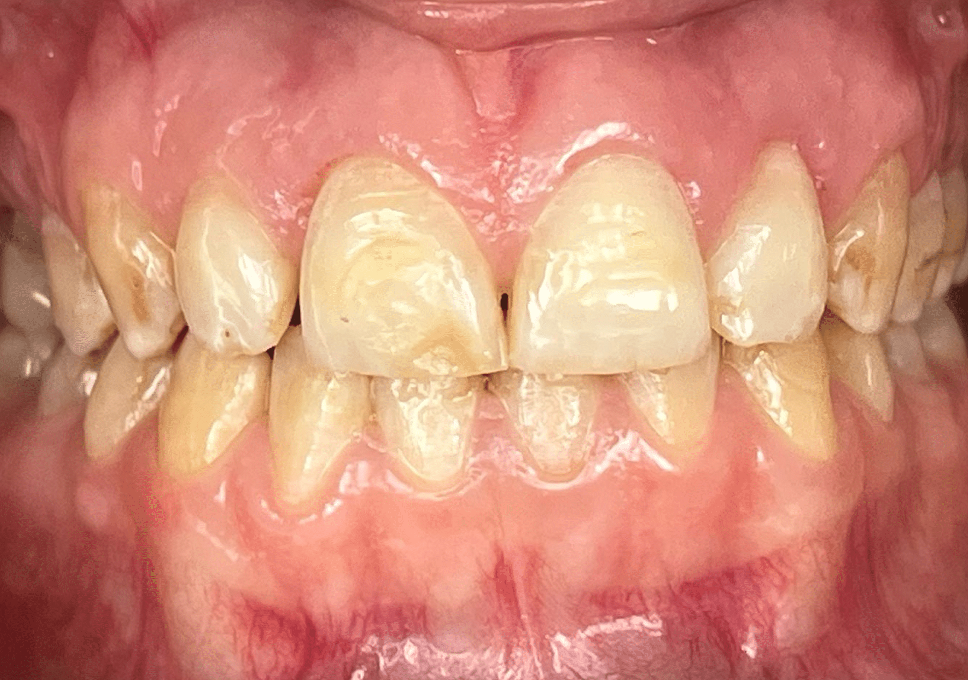 Antes y después - Dr Marc Rovira