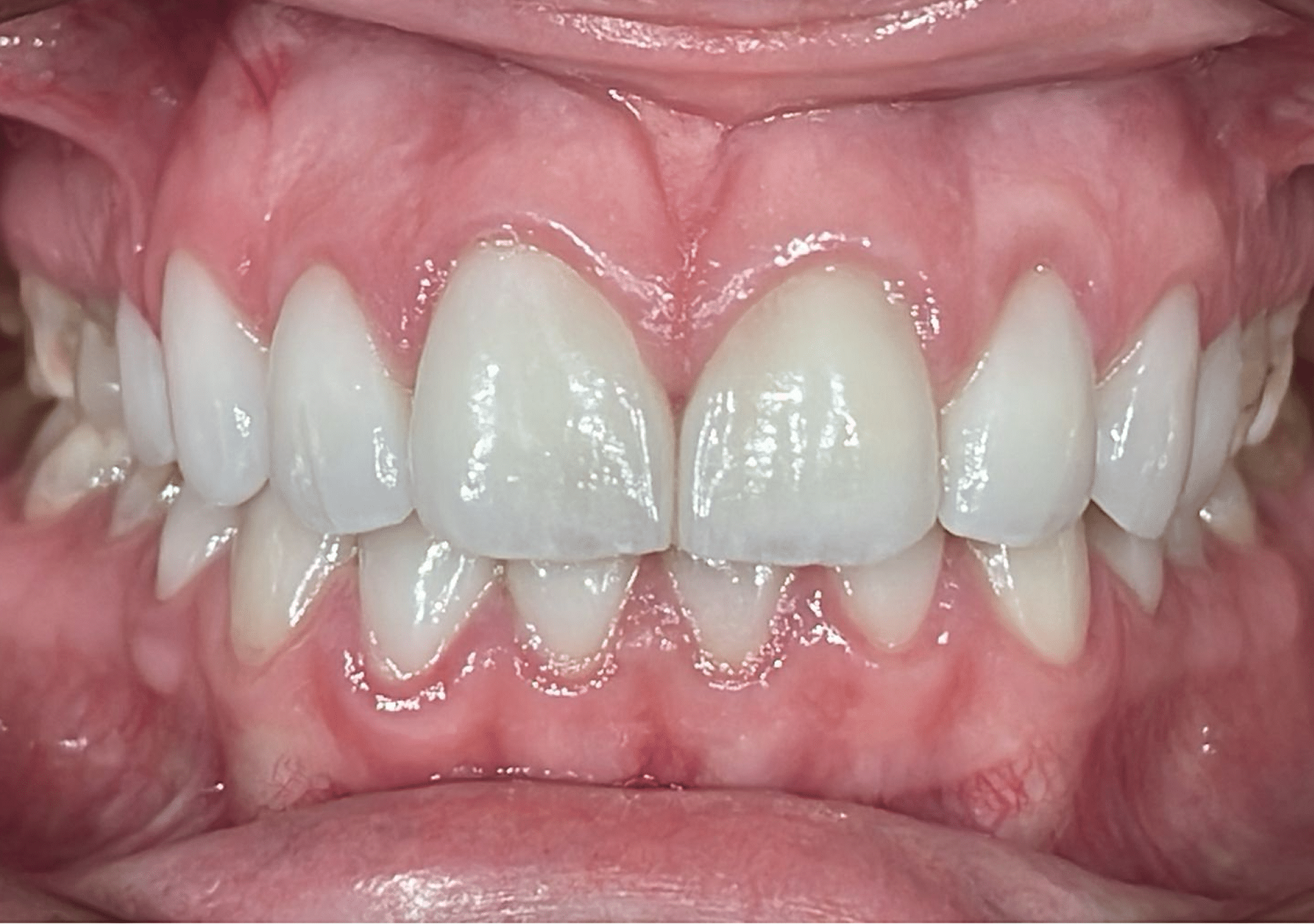 Antes y después - Dr Marc Rovira