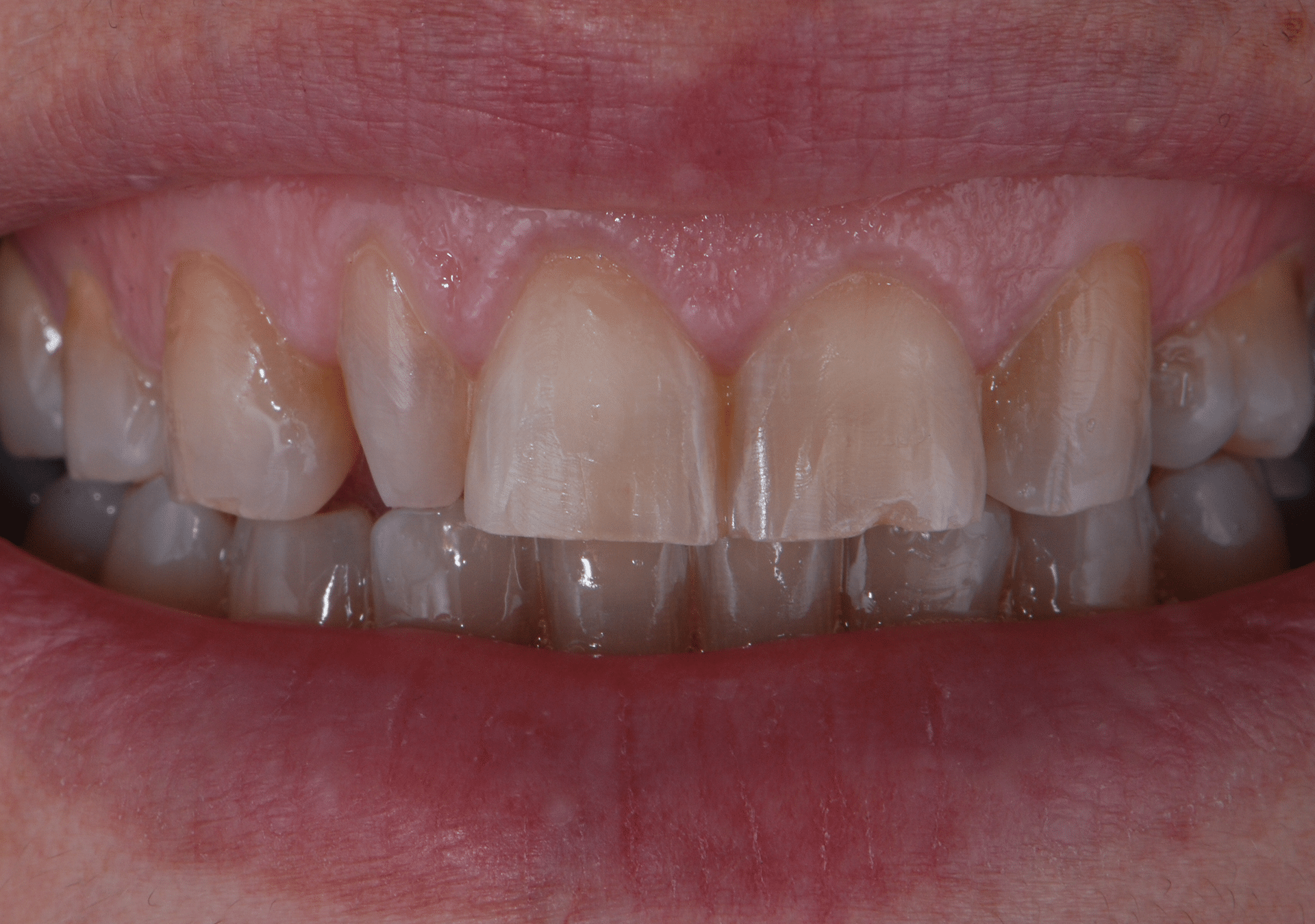 Antes y después - Dr Marc Rovira